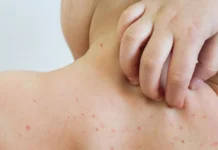 Alerta epidemiológica por la detección de un caso de sarampión