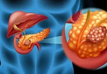 Cáncer de páncreas: científicos españoles lograron eliminarlo en un estudio con ratones