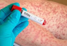 Argentina registró 46.799 casos de sífilis en 2025, la tasa más alta desde 2011