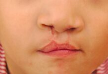 Misiones aprobó un programa para acompañar a pacientes con labio leporino