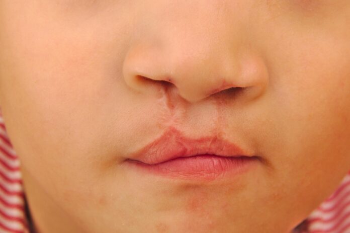 CleftlipandPalate_share